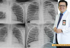 Fakta Seputar Penyakit  Mycoplasma Pneumonia yang Kini Naik di Cina
