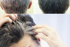 Usia Muda Rambut Sudah Beruban, Ini Cara Alami yang Bisa Dilakukan