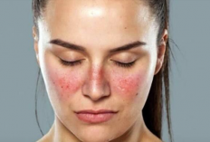 Wajib Paham, Ini Perbedaan Penyakit Lupus dengan Alergi bagi Orang Awam