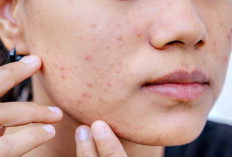  Jangan Tergiur Iklan Medsos, setiap Kulit Miliki Karakteristik Unik