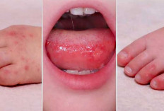 Flu Singapura Rentan Menyerang Anak-Anak