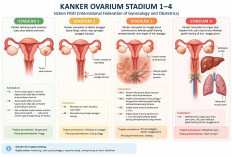 Wanita Usia Produktif Wajib Aware, Kanker Ovarium Bisa Menyebar ke Bagian Tubuh Lain