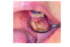 Yuk Mengenal Komplikasi Pasca Pencabutan Gigi Dry Socket