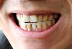 Karang Gigi Bikin Nggak PD? Jangan Khawatir, Ini 8 Cara Alami Menghilangkan Karang Gigi, Tanpa Perlu ke Dokter