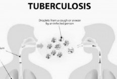 Mengenal Penyakit Tuberkulosis Paru Gejala, Diagnosis, dan Penanganan