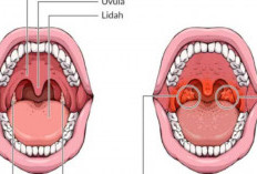 Mengenal Gejala dan Pengobatan Radang Amandel Secara Tuntas, Perhatikan Baik-baik Ya!