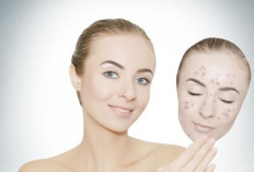 Rekomendasi Krim Penghilang Flek Hitam Terbaik untuk Wajah Cerah Berseri