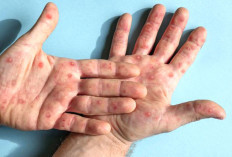 Moms Jangan Sampai Terlambat, Kasus Campak yang Berat Bisa Berdampak ke Otak