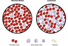 Mengurangi Risiko Leukemia, Berikut Langkah Pencegahan dan Pengobatan yang Efektif