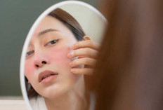  Ini Gejala Penyakit Lupus yang Harus Kamu Waspadai