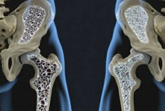Mengenal Lebih Jauh Tentang Osteoporosis: Ini Tanda, Pencegahan, dan Pengobatannya!