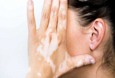  Kenali Penyebab dan Risiko Vitiligo Pada Kulit