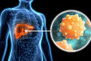 Yuk Kenali Gejala Hepatitis pada Anak