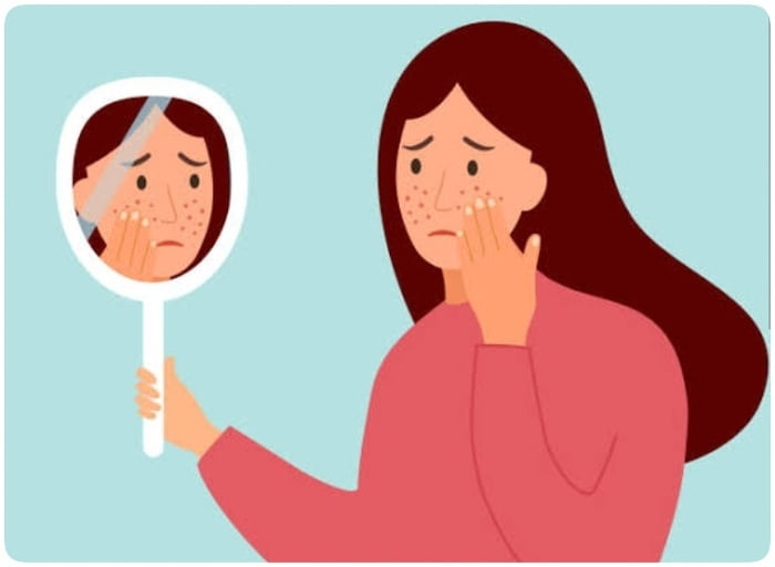 Wanita Harus Paham, Ini loh Bahan Skincare yang Aman untuk Kulit Berjerawat